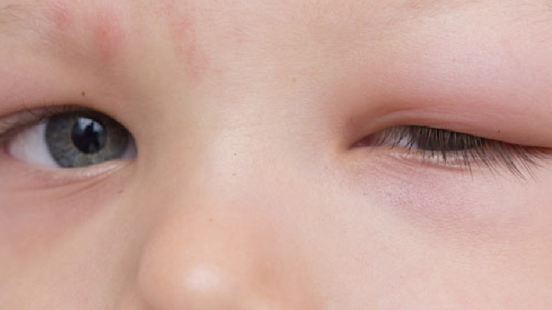 眼敏感, 兒童眼敏感, 眼敏感原因, 小朋友眼敏感