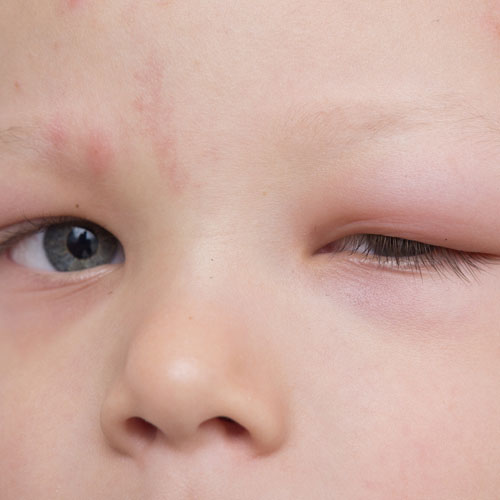img/eye-allergy-child.jpg