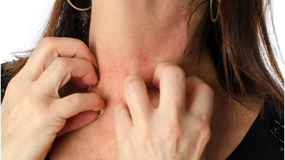 為何成人局部皮膚過敏越來越普遍?