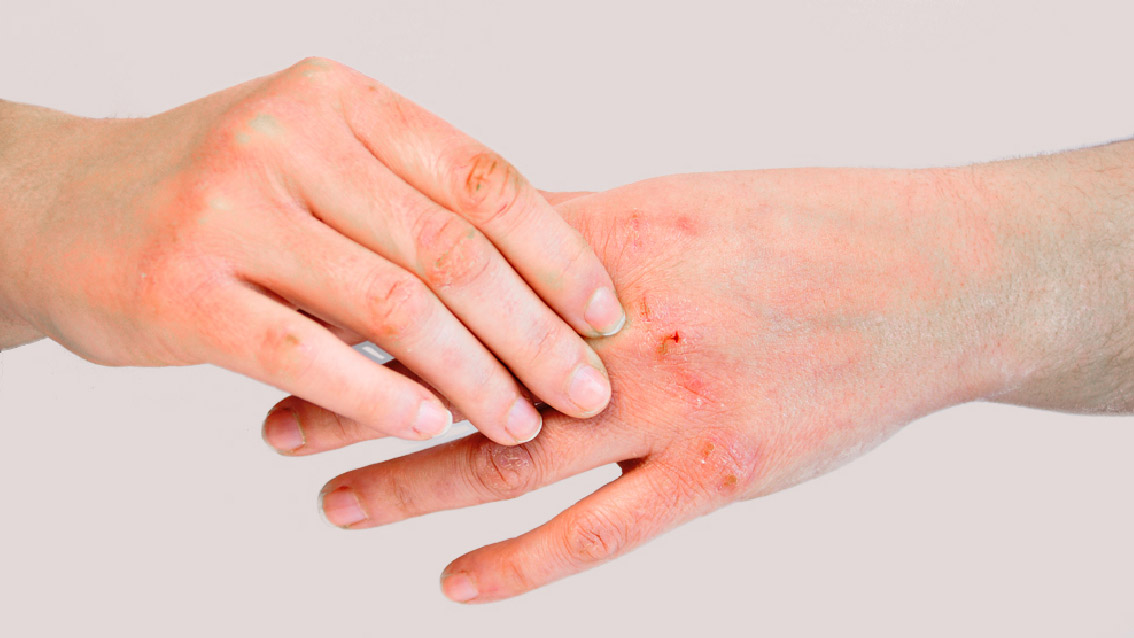 Hand eczema cure, reasons of itchy palm and hand eczema